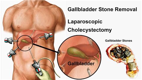 Understanding Gallstones And Gallbladder Surgery A Simplified Guide Heal Well Speciality Clinic