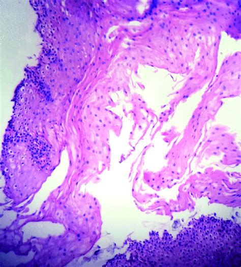 Biopsy of an endoscopically obtained sample of the esophagus (× 10 ...