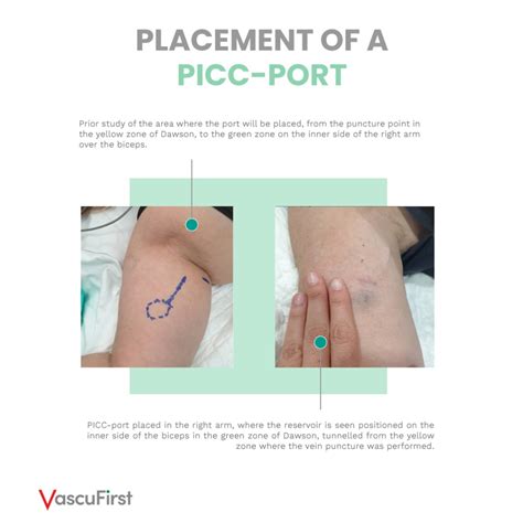 Tips For Proper Picc Port Placement Vascufirst