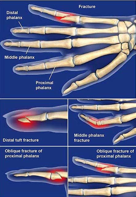 Proximal Phalanx Fracture Splint