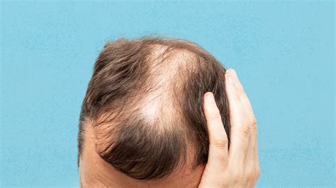 What Is Alopecia Areata Symptoms Causes Diagnosis And Treatment