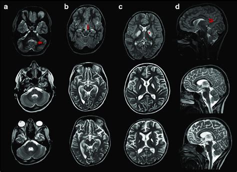 T2 Weighted Brain Mri Showing Bilateral Hyperintensities In Dentate Download Scientific Diagram