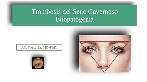 Trombosis Del Seno Cavernoso Etiopatogénia Youtube