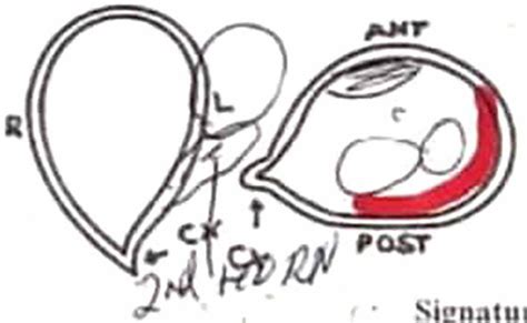 Sonologist Impression Of The Uterine Didelphys With Pregnancy In The