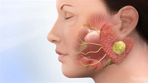 Parotid Tumor: Overview - ENTJC