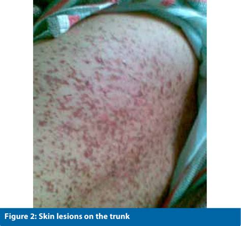 Figure 2 From Stevens Johnson Syndrome Toxic Epidermal Necrolysis