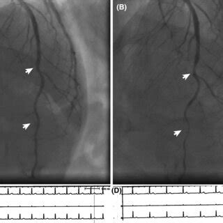 Regadenoson Electrocardiographic And Spect Findings In Patient Panel