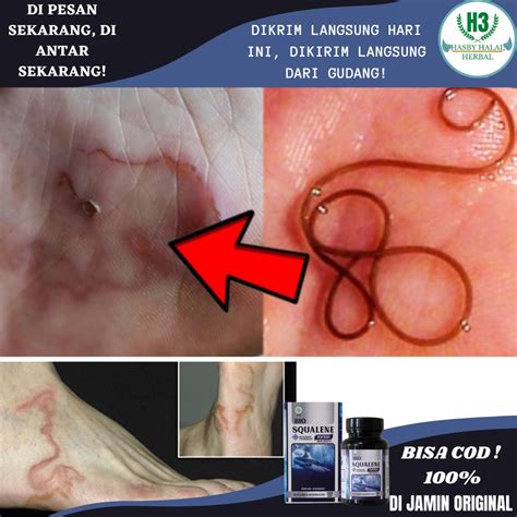 Jual Obat Cacing Pasir Cutaneous Larva Migrans Cacing Pasir Di Kulit