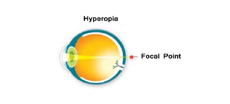 Hyperopia And Farsightedness Symptoms Causes Diagnosis Treatment