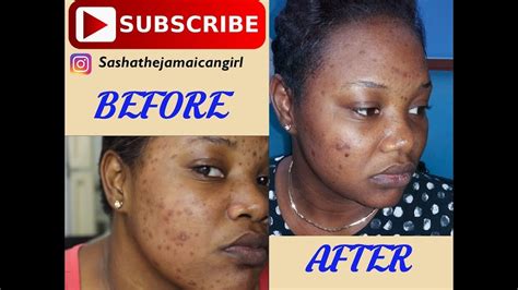 How To Get Rid Of Acne Spots And Dark Marks Fast Microdermabrasion