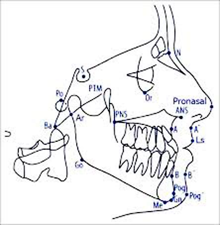 Lateral Cephalometric Radiograph Prestige Dental Care My