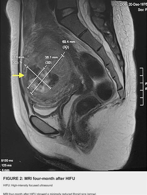 Figure 1 From Successful Control Of Heavy Menstrual Bleeding Using High