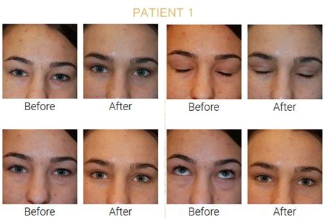 Eyelid Surgery Blepharoplasty Before And After Pictures Eyelid