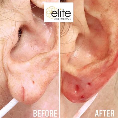 Minor Skin Procedures Earlobe Repair Lesion Removal Elite Aesthetics