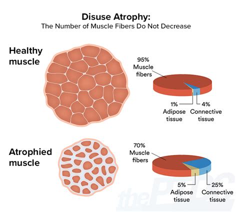 How to Fight Muscle Atrophy After Injury: A Personal Trainer’s Guide