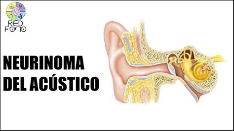 Neurinoma del Acústico Schwanomma Vestibular YouTube