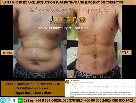 Low Cost Body Contouring Thailand Fat Removal Bangkok Urban Beauty