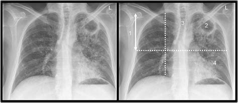 A Posterior Anterior Chest Radiograph In A Patient With Typical