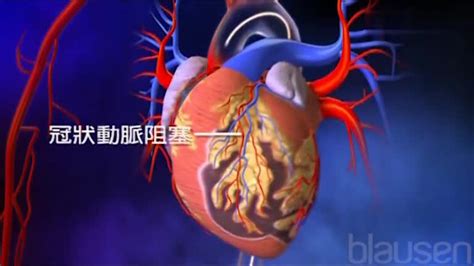 医学3d动画演示：冠状动脉狭窄介入成形术、支架植入术 健康视频 搜狐视频