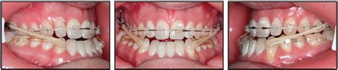 Nonsurgical Correction Of Severe Skeletal Class Iii Malocclusion Jco Online Journal Of