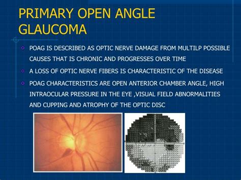 Ppt Primary Open Angle Glaucoma Powerpoint Presentation Id 3925500