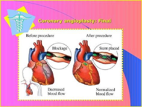 Nurserevieworg Angioplasty Vs Bypass