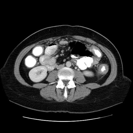 Ulcerative Colitis Image Radiopaedia Org