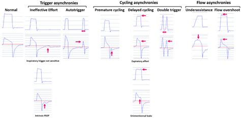 The most common patient–ventilator asynchronies can be detected by... | Download Scientific Diagram