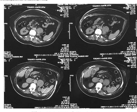 Figure 1 From Simultaneous Bilateral Laparoscopic Adrenalectomy For