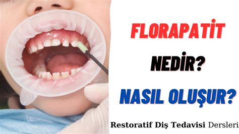 Florapatit Nedir Nas L Olu Ur Dus Taki Nemi Dus Restoratif Di