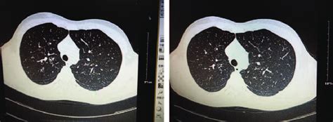 A Saccular Bronchiectasis Of The Right Upper Lobe B Reversal Of Download Scientific