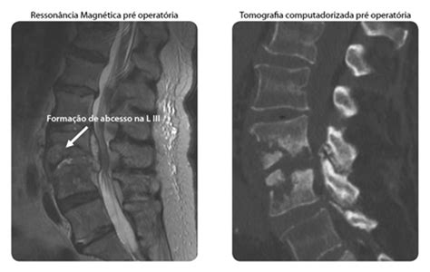 Osteomielite Tratamento De Infecções ósseas Dra Ana Paula Simões