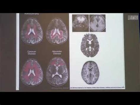 25 MRI Based Approach To Neurometabolic Disorders By Hamza Alsayouf SD