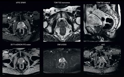 Including MRI in radiation therapy planning - FieldStrength MRI ...