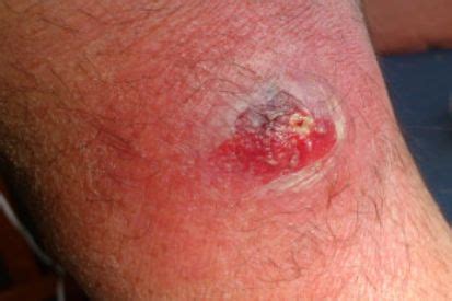 Abscess Boil Symptoms And Treatment Lupton Dermatology