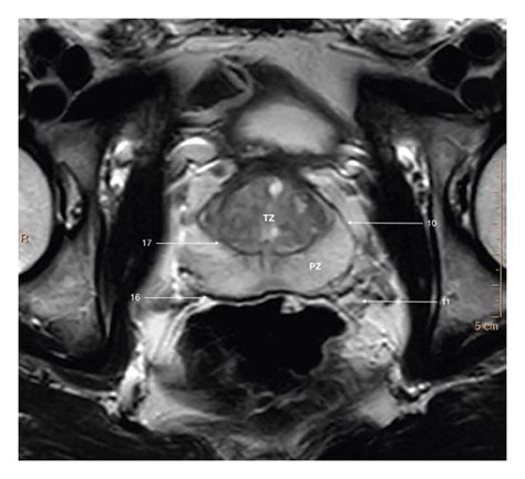 T2 Weighted Axial Image Of A Prostate Gland Of A Young Patient Showing Download Scientific