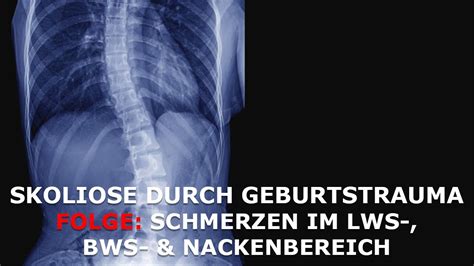 Skoliose Und Schmerzen Im Lws Bws Und Hws Bereich Durch Ein