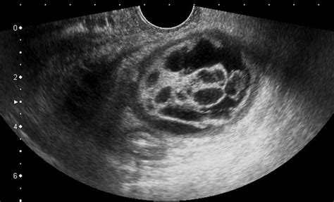 Ovarian Dermoid Cyst Ultrasound