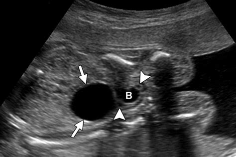 Fetal Ovarian Cyst Ultrasound