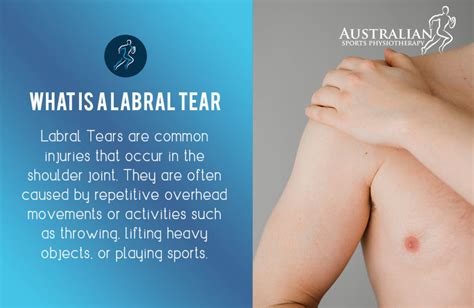 Shoulder Labral Tear Physiotherapy Australian Sports Physio