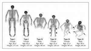 Osteogenesis Imperfecta Types – IPOD India