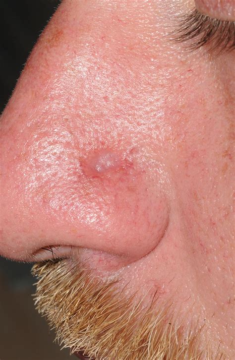 Syphilis Face Rash