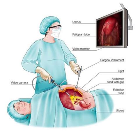 Laparoscopy Diagnosis Treatment Of Unexplained Infertility