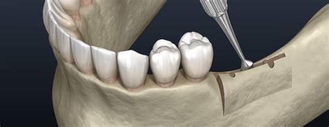 What Is Alveoloplasty Oral Surgeon Mesa AZ