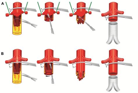 Circumferential Aortic Endarterectomy Followed With Immediate Infrarenal Clamping Obviates