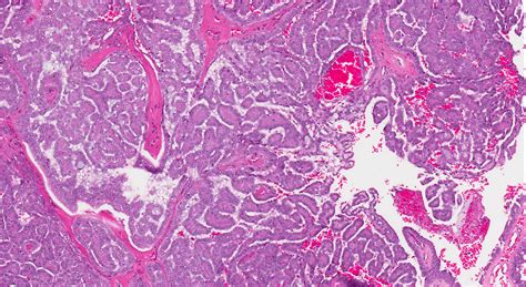 Pathology Outlines Polymorphous Adenocarcinoma