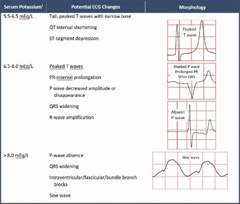 Sine Wave Hyperkalemia Ecg Changes