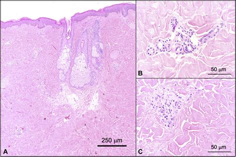 Localized scleroderma (morphea). Expansion of the dermis by thickened ...