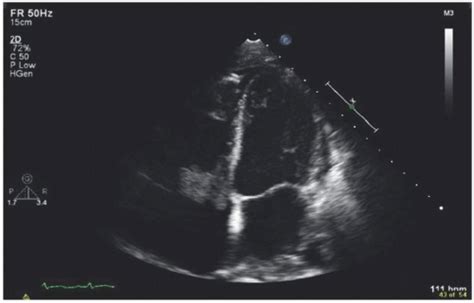 Endocarditis And Other Pathologic And Normal Anatomic Variants Thoracic Key