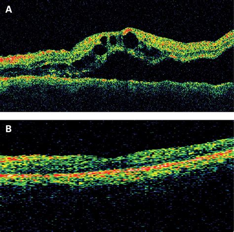 Giant Retinal Pigment Epithelial Tear After Laser Photocoagulation For